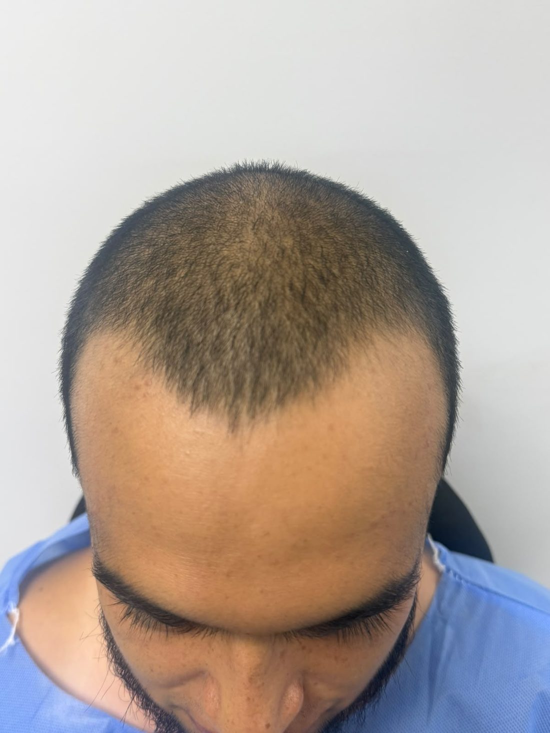 Caso 3: evolución al mes 3 del implante capilar